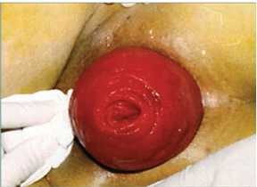 Ⅱ度：有效性直肠脱垂，不合并肛管脱垂。